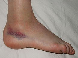 a láb és a bokaízület duzzanata mit kell venni a könyökízület artrózisával