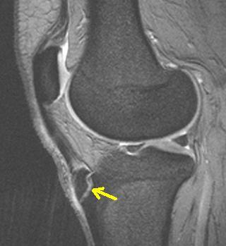 risonanza magnatica morbo osgood schlatter